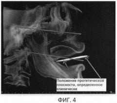 Способ определения расположения протетической верхней плоскости у пациентов с нарушениями целостности зубных рядов (патент 2470587)