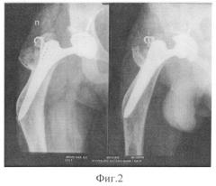 Способ эндопротезирования тазобедренного сустава при наличии деформации диафиза бедра (патент 2538050)