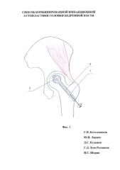 Способ комбинированной импакционной аутопластики головки бедренной кости (патент 2583577)