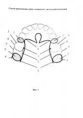 Способ перемещения зубов у пациентов с дистальной окклюзией (патент 2641000)