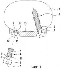 Медицинский имплантат с зафиксированным винтом для остеосинтеза (патент 2307617)
