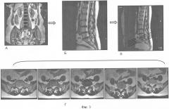 Способ выявления остеохондроза пояснично-крестцового отдела позвоночника (патент 2382603)