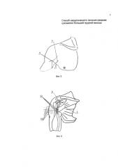 Способ хирургического лечения застарелого разрыва сухожилия большой грудной мышцы (патент 2585412)
