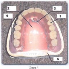 Миодинамический мягкий полный съемный протез. способ изготовления миодинамического мягкого полного съемного протеза (патент 2384308)