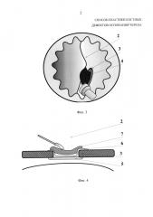 Способ пластики костных дефектов основания черепа (патент 2598457)