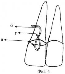 Метод постоянной иммобилизации при переломах нижней челюсти (патент 2463974)
