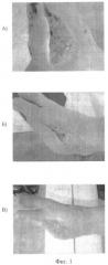 Способ лечения нейротрофических язв конечностей (патент 2446811)