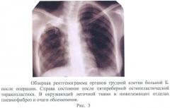 Способ лечения деструктивного туберкулеза легких (патент 2475192)