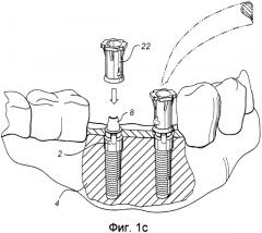 Способ обеспечения индивидуальной для пациента конструкции, сопрягающейся с зубным фиксатором (патент 2575144)