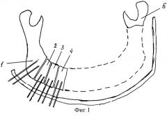 Способ замещения обширных дефектов нижней челюсти (патент 2253391)
