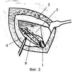 Способ безнатяжной комбинированной пластики пахового канала по петрову-кошеву (патент 2303403)