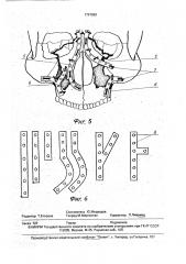 Способ лечения переломов костей средней зоны лицевого черепа (патент 1797869)