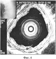 Способ диагностики пищевода баррета (патент 2343839)
