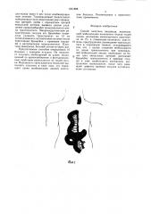 Способ пластики пищевода (патент 1621895)