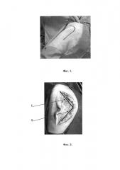 Способ экспериментального хирургического доступа к тазобедренному суставу при переломах вертлужной впадины (патент 2654008)