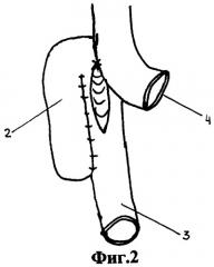 Способ формирования межкишечного анастомоза (патент 2272586)