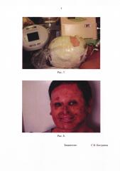 Способ хирургического лечения больных с тотальными рубцовыми деформациями лица (патент 2655832)