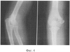 Способ лечения апофизеолизов медиального надмыщелка плечевой кости у детей (патент 2327428)