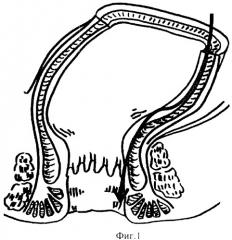 Способ восстановления непрерывности толстой кишки (патент 2444313)