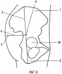 Способ определения глубины введения иглы для блокады верхнего ягодичного нерва (патент 2400157)