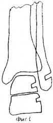 Способ устранения нестабильности голеностопного сустава при застарелом повреждении передней малоберцово-таранной и малоберцово-пяточной связок (патент 2270625)