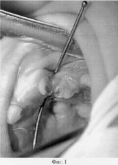 Способ реконструкции альвеолярного отростка верхней челюсти у больных с врожденными расщелинами (патент 2286730)