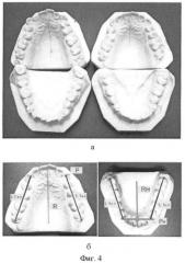 Способ биометрической диагностики направления и величины перемещения зубов при ортодонтическом лечении (патент 2436538)
