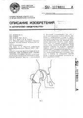 Способ внесуставной коррекции при юношеском эпифизеолизе головки бедра (патент 1174011)