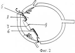 Способ хирургической коррекции тотальной аниридии, сочетанной с афакией в однокамерном глазу (патент 2247546)