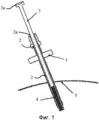 Медицинский инструмент для микроинвазивного применения (патент 2481812)