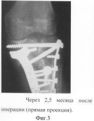 Способ остеосинтеза с использованием костной аллопластики (патент 2299028)