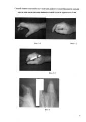 Способ кожно-костной пластики при дефекте тканей фаланги пальца кисти при наличии нефункциональной культи другого пальца (патент 2586311)