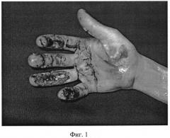 Способ васкуляризированной кожной пластики дистальных отделов пальцев кисти островковым осевым лоскутом на временной питающей ножке (патент 2544100)