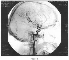 Способ церебральной ангиографии (патент 2348359)