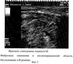 Способ ультразвуковой диагностики рецидивов мягкотканых сарком и фиброзных изменений (патент 2311129)