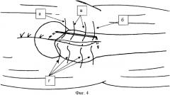 Способ реинсерции сухожильно-мышечного обшлага вертельной области бедра при эндопротезировании тазобедренного сустава (патент 2381011)