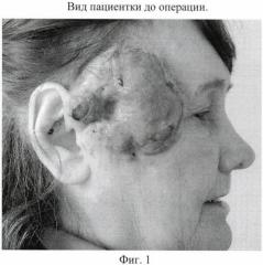 Способ хирургического лечения распространенного рака кожи околоушной области с метастазами в лимфатические узлы шеи (патент 2445005)