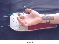 Устройство для восстановления функции пальцев кисти (патент 2324465)