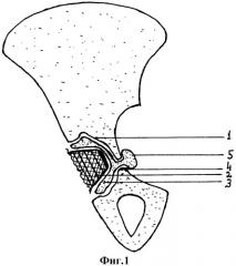 Способ цементной фиксации вертлужного компонента при тотальном эндопротезировании тазобедренного сустава у больных с остеопорозом (патент 2312629)