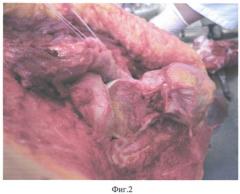 Способ анатомо-хирургического моделирования угла горизонтальной инклинации в тазобедренном суставе человека в эксперименте (патент 2547781)