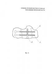 Способ лечения внутрисуставных переломов пяточной кости (патент 2630870)