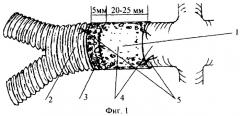 Способ профилактики аневризм при реконструкциях аорты и магистральных артерий и устройство для его осуществления (патент 2245109)