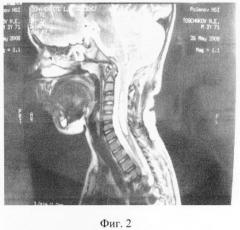 Способ лечения сирингомиелии (патент 2373867)