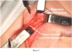 Способ низведения яичка при абдоминальной ретенции после пересечения тестикулярных сосудов (патент 2498780)