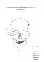 Способ фиксации наружного носа и перегородки полости носа. (патент 2626125)