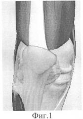 Способ хирургической реинсерции m. vastus medialis obliquus при посттравматической латеральной пателлярной дислокации с использованием артроскопических технологий (патент 2354316)