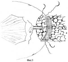 Способ формирования панкреатоеюноанастомоза (патент 2261059)