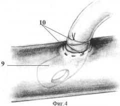 Способ временного сосудистого шунтирования при трансплантации и аутотрансплантации печени (патент 2317010)