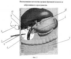 Способ диагностики патологии органов брюшной полости и забрюшинного пространства (патент 2262303)