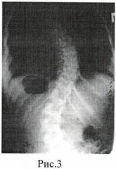 Способ коррекции s-образного идиопатического сколиоза у детей (патент 2460470)
